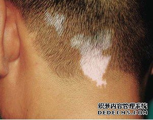 如何知道自己得了白癜风